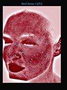 赤ら顔の解析